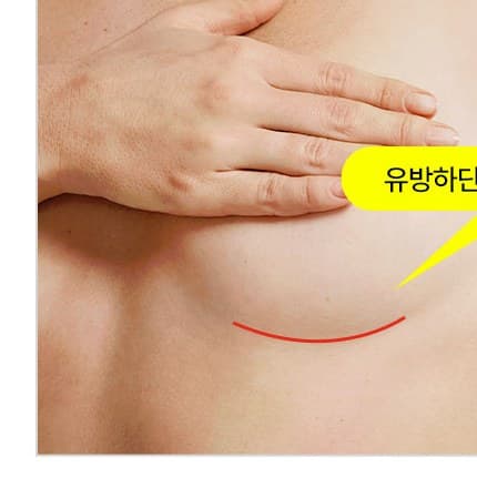 유방아래 주름절개법 (가슴 밑선 절개법) 이미지
