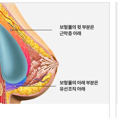 듀얼플레인 수술법 단면도