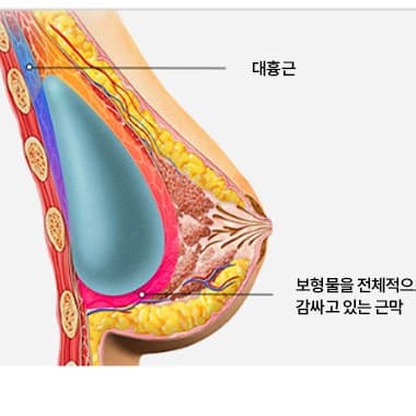 근막하 삽입 수술법 단면도