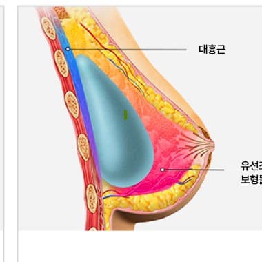 유선안 삽입 수술법 단면도